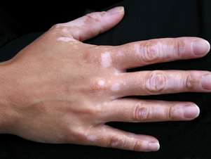A técnica de repigmentação serve também para tratar o vitiligo Foto: Getty Images
