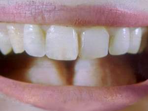 Dente recriado na China é rudimentar e menos rígido que o dente humano natural Foto: BBCBrasil.com