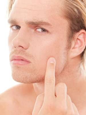 Originada principalmente por conta da presença do hormônio masculino andrógeno, a acne pode se tornar um pesadelo para a pele masculina quando tratada da maneira incorreta Foto: Shutterstock