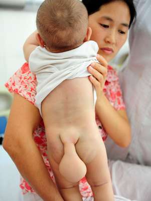 Menino chinês nasceu com uma "cauda". Segundo médicos, protuberância não pode ser retirada com cirurgia - pelo menos, não agora Foto: The Grosby Group
