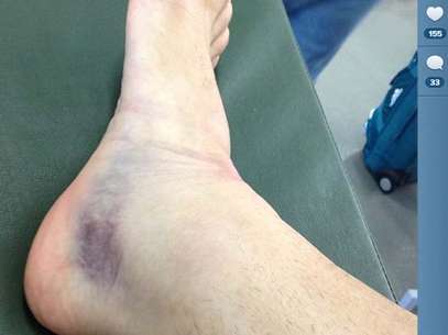 Maikon Leite publicou foto do pé machucado em rede social Foto: Instagram / Reprodução
