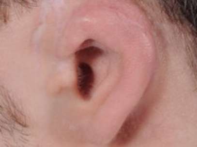 Médicos reconstruíram orelha de Hogg com pedaço de sua costela  Foto: BBCBrasil.com