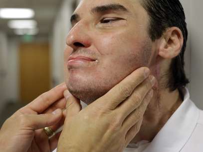 Médico examina a pele de Richard Norris: transplantado hoje se sente confiante o suficiente para aparecer em público Foto: AP