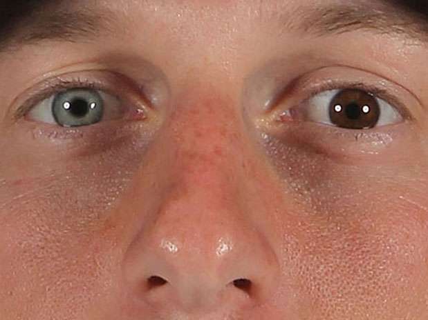 Max Scherzer, jogador norte-americano de basebol, tem uma grande diferença nas cores dos olhos Foto: Getty Images Max Scherzer, jogador norte-americano de basebol, tem uma grande diferença nas cores dos olhos Foto: Getty Images
