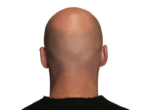 A partir dos 50 anos, mais da metade dos homens sofre de calvície Foto: Getty Images A partir dos 50 anos, mais da metade dos homens sofre de calvície Foto: Getty Images