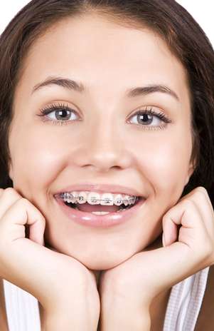 Cada vez mais, os aparelhos ortodônticos se espalham pelos sorrisos, não só de crianças, como de adultos. Além de corrigir o alinhamento dos dentes, o tratamento previne uma série de problemas relacionados com articulação dental incorreta. Mas, para ter apenas resultados positivos, é preciso ter atenção redobrada com a higiene bucal. Isso porque a escova e o fio dental encontrarão mais obstáculos na boca, como braquetes, fios e bandas.  Foto: Shutterstock Cada vez mais, os aparelhos ortodônticos se espalham pelos sorrisos, não só de crianças, como de adultos. Além de corrigir o alinhamento dos dentes, o tratamento previne uma série de problemas relacionados com articulação dental incorreta. Mas, para ter apenas resultados positivos, é preciso ter atenção redobrada com a higiene bucal. Isso porque a escova e o fio dental encontrarão mais obstáculos na boca, como braquetes, fios e bandas.  Foto: Shutterstock