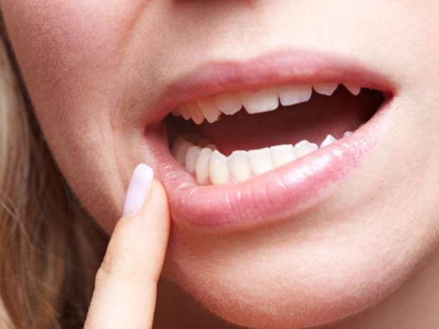 Sempre é preciso remover o dente do siso?  O dente do juízo perdeu a sua popularidade nos últimos tempos. Mas, se o siso nascer na posição correta e houver espaço na boca para seu crescimento, pode não representar risco para a saúde bucal.   Foto: Shutterstock Sempre é preciso remover o dente do siso?  O dente do juízo perdeu a sua popularidade nos últimos tempos. Mas, se o siso nascer na posição correta e houver espaço na boca para seu crescimento, pode não representar risco para a saúde bucal.   Foto: Shutterstock