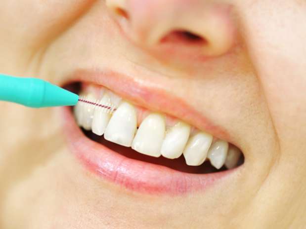 O fio dental e a escova interdental chegam a lugares que a escova no alcana e eliminam restos de alimento e bactrias que ficam entre os dentes.  Foto: Shutterstock
