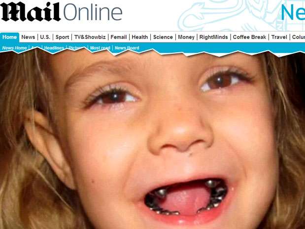 Segundo dentista pediátrico, o procedimento foi necessário devido ao alto nível de deterioração  Foto: Reprodução